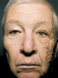 homem com a pele envelhecida de um lado do rosto por conta do sol
